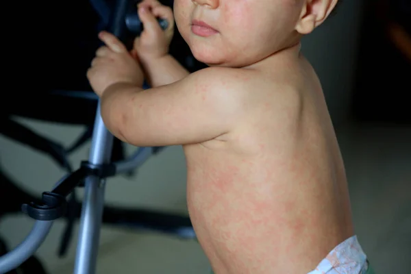 Niño con síntomas de sarampión —  Fotos de Stock