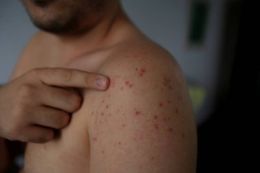 Salvador, Bahia / Brezilya - 11 Nisan 2019: İnsan vücudunda Roseola olarak bilinen el ve ayak ve ağız sendromu belirtileri gösterir.