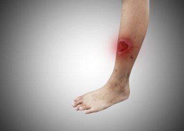 wounded leg , isolated on white background clipart