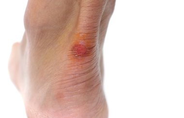 Yara bir topuk ayakkabı sokması nedeniyle, closeup 