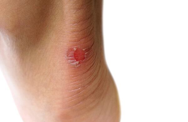 Closeup of wound at a heel due to shoe bites 