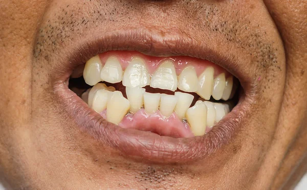 Denti storti faccia uomo — Foto Stock