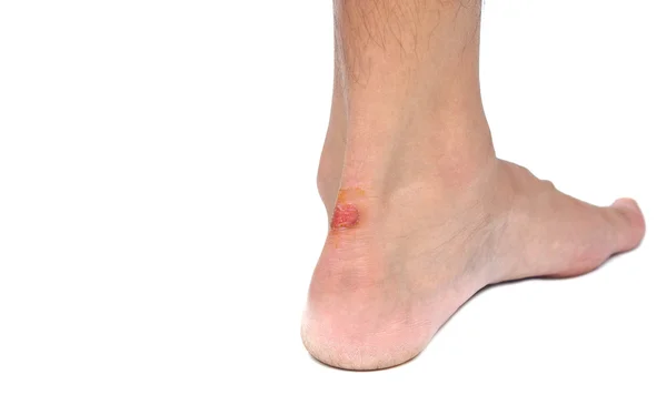 Närbild av såret på en häl på grund av sko biter — Stockfoto
