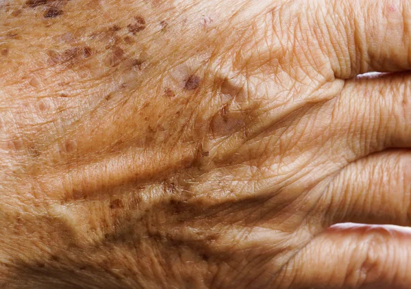 Freckle en primer plano de la piel — Foto de Stock