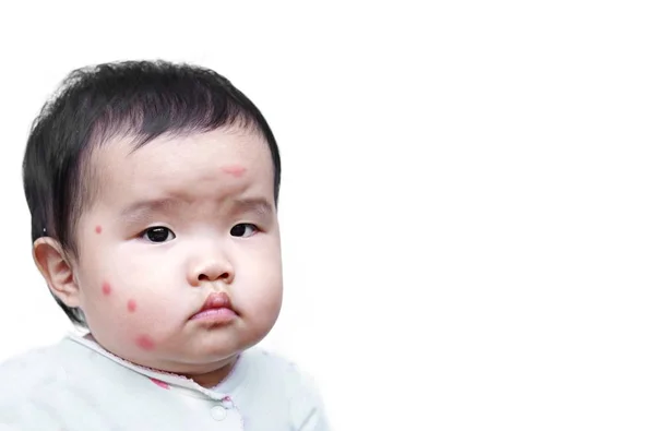 Cara de bebê com picadas de mosquito — Fotografia de Stock