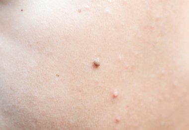 İnsan yüzünde köstebek 