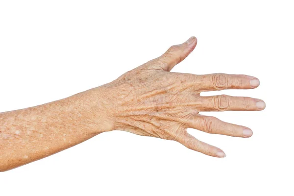 Female hand full of freckles — Stock Photo, Image