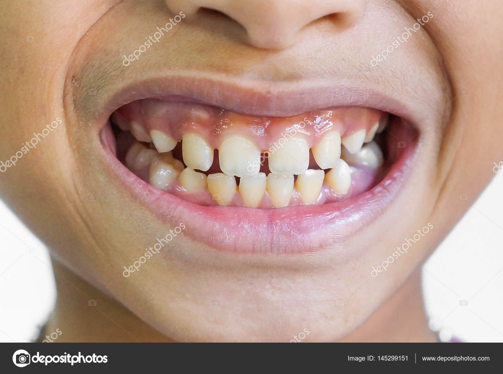 бетон. отсутствие щелей. зубы. отсутствие щелей. рентгеновский снимок тазобедренного сустава при коксартрозе.