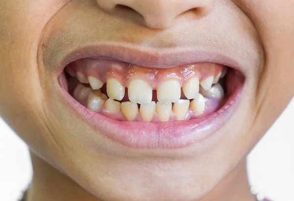 Elülső fogak hiányosságok / Diastemas — Stock Fotó