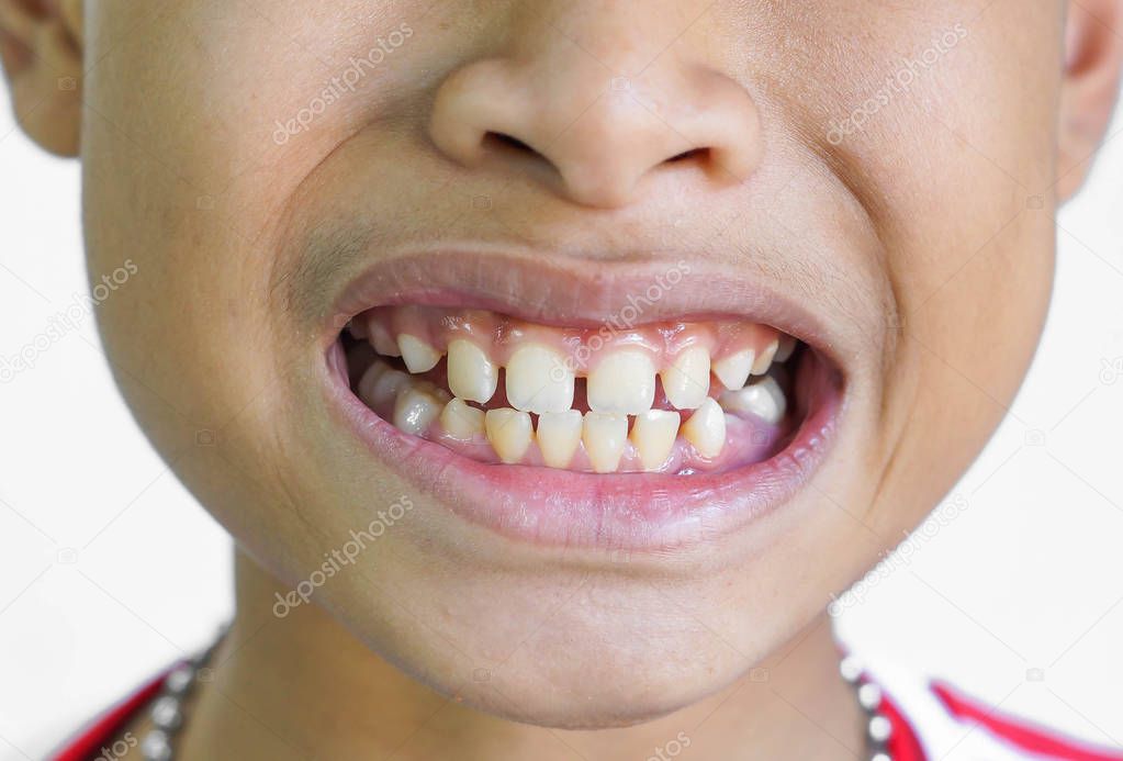 Front teeth gaps / Diastemas