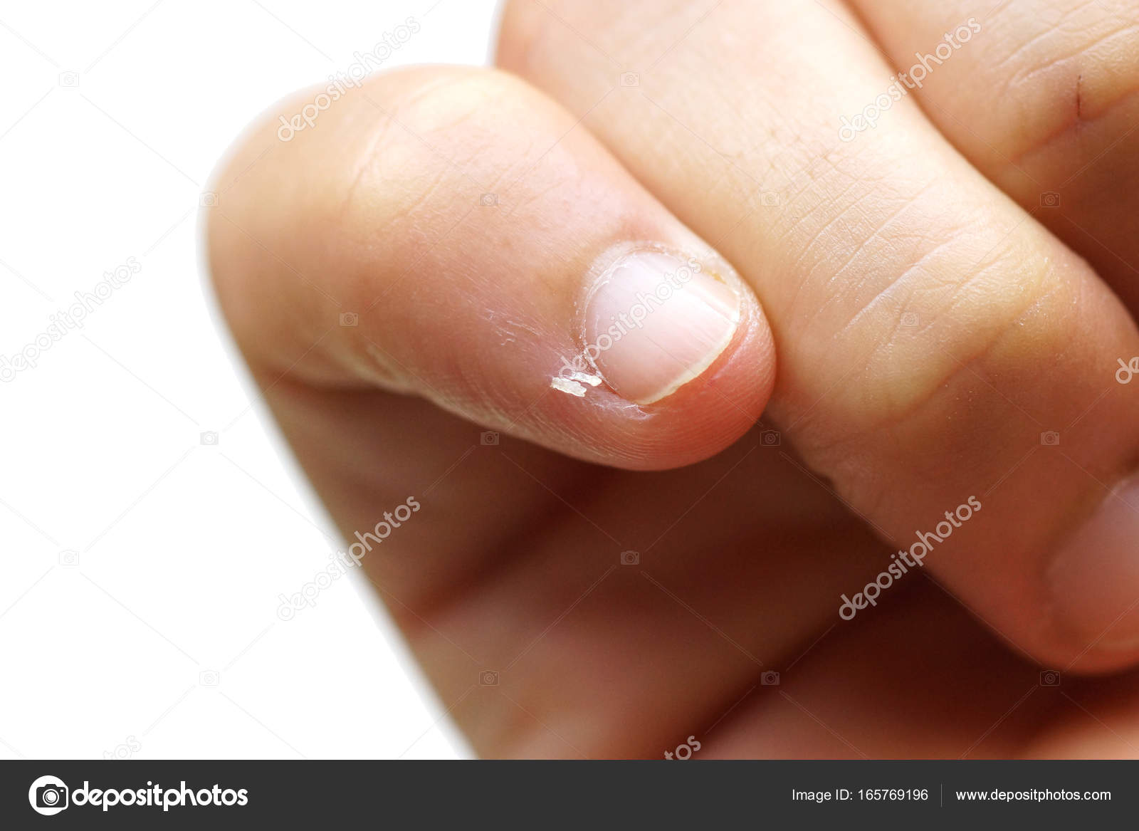 Close-up of fingers and nails with dry skin, torn and flaking off, cracked  skin on cuticles, dry brittle nails. Broken fingernails inflammation.  Chipped nails. Isolated on white background. 10354690 Stock Photo at