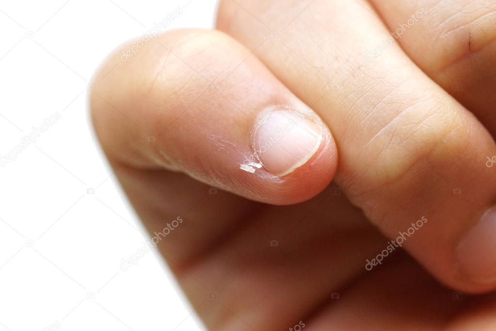 Nail skin peeling     