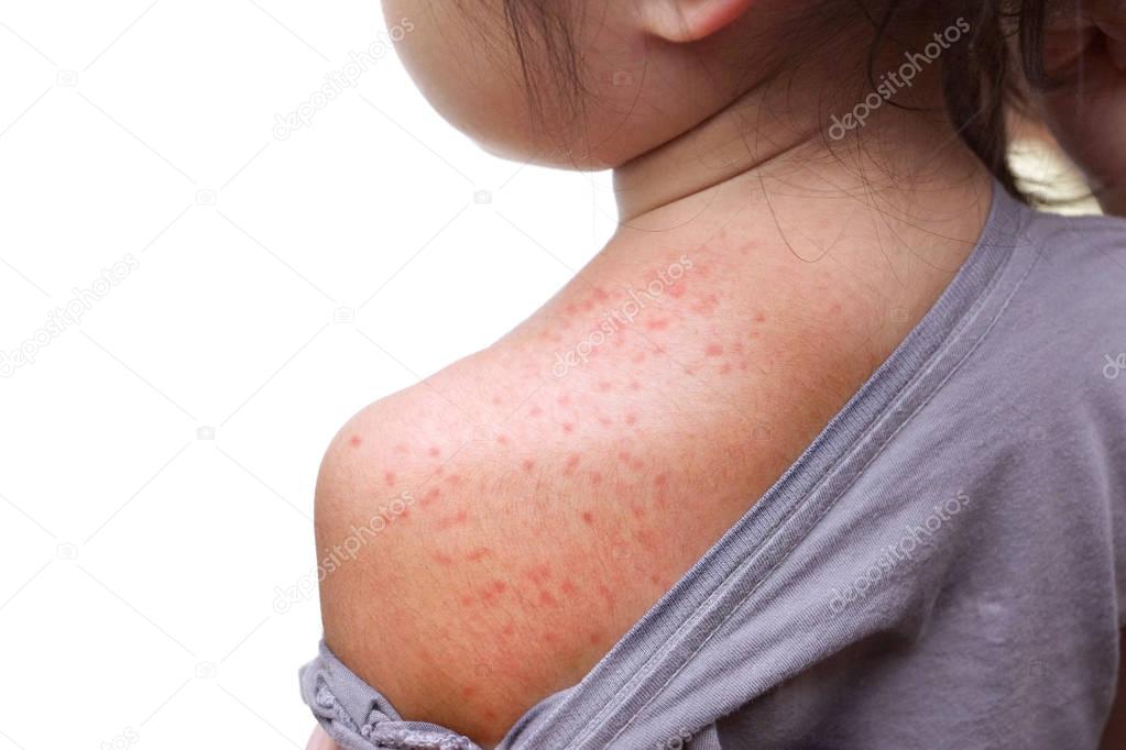 Red rash on baby skin 