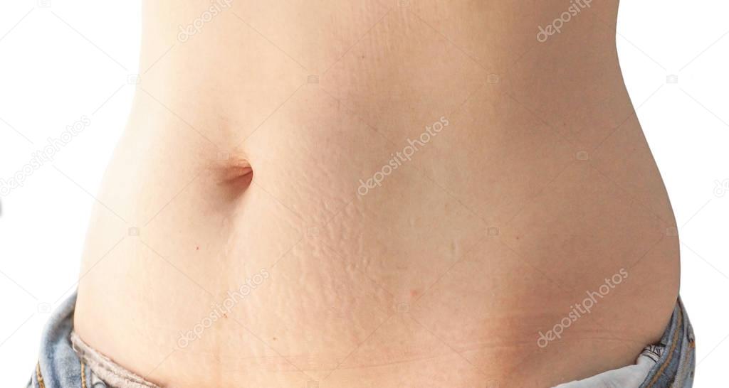 Stretch marks isolated on white