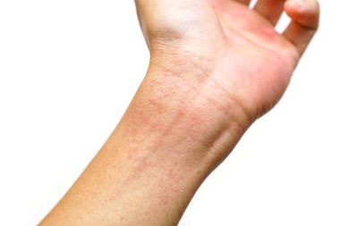 Beyaz arka planda izole edilmiş bilekteki kızarıklık / virüsün sebep olduğu ciltteki kızarıklık