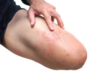Red rash on leg isolated on white background / Rashes with virus clipart