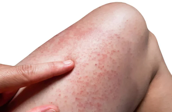 Red Rash Leg Isolated White Bacjground Rashes Virus — Stock Photo, Image