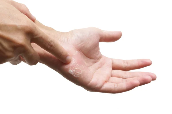 Χέρι Ξεφλούδισμα Του Δέρματος Απομονώνονται Λευκό Φόντο — Φωτογραφία Αρχείου