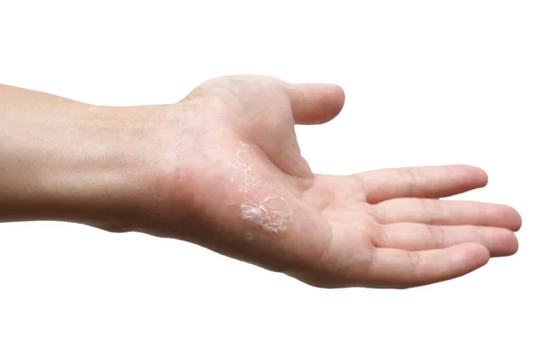 Hand Hud Peeling Isolerad Vit Bakgrund — Stockfoto