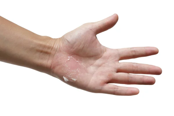 Peeling Della Pelle Della Mano Isolato Sfondo Bianco — Foto Stock