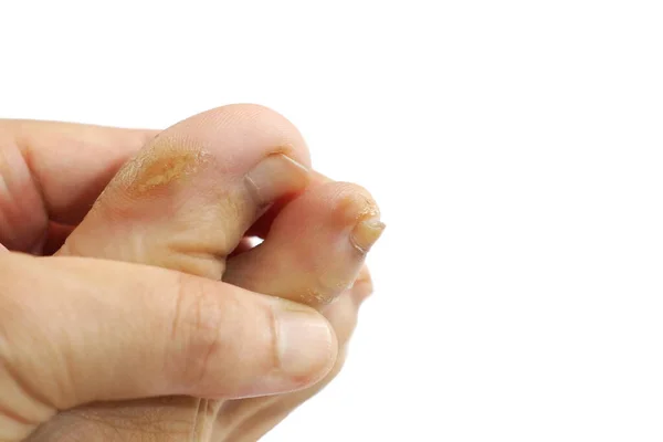 Runner Toes Problem Isolated White Background — Stock Photo, Image