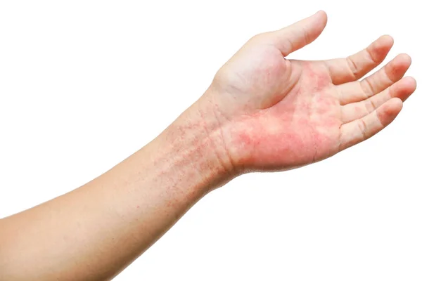 Red Rash Wrist Hand Isolated White Background Rashes Skin Caused — Stock Photo, Image