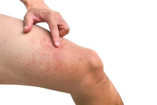 Red Rash Leg Isolated White Background Rashes Virus — Stock Photo, Image