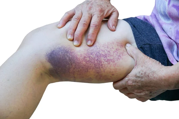 Old Female Leg Full Bruise Isolated White — Stock Photo, Image