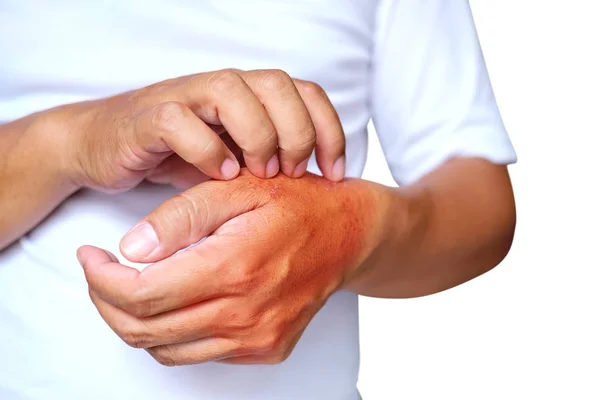 Comichão de doenças de pele em homens usando o arranhão da mão. Vermelho a — Fotografia de Stock