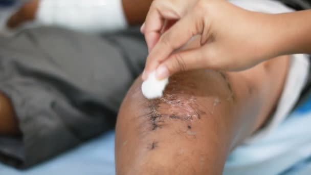 La mano de la mujer que usa algodón para limpiar la herida de la cirugía fractura de la rodilla del hombre — Vídeos de Stock