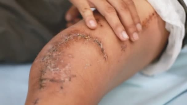 Hand der Frau mit Baumwolle zur Reinigung der Wunde gebrochenen Knochen Knie des Mannes — Stockvideo