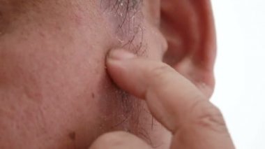 4k yara deri döküntü Dermatit sedef hasta kaşıntılı çizik tırmalamak adam shot eller yukarı kapatın