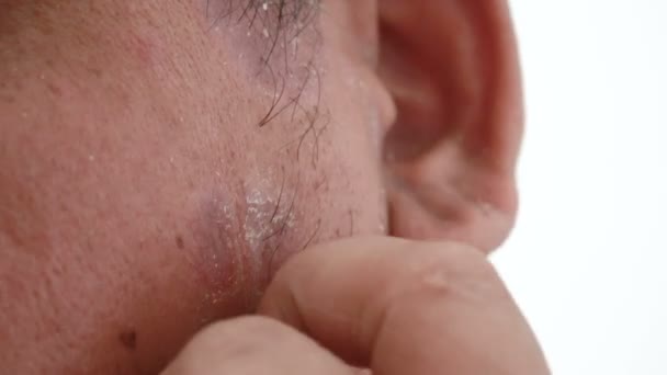 Close Shot Handen Van Man Huid Uitslag Dermatitis Psoriasis Patiënten — Stockvideo