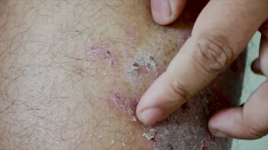 4k yara deri döküntü Dermatit sedef hasta kaşıntılı çizik tırmalamak adam shot eller yukarı kapatın