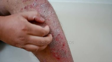 4k yara deri döküntü Dermatit sedef hasta kaşıntılı çizik tırmalamak adam shot eller yukarı kapatın