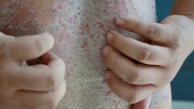 4k yara deri döküntü Dermatit sedef hasta kaşıntılı çizik tırmalamak adam shot eller yukarı kapatın