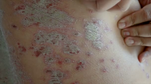 Primo Piano Colpo Mani Uomo Graffiare Eruzione Cutanea Dermatite Psoriasi — Video Stock