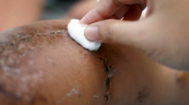 Cerrahi yara kırık kemik diz adamın temizlik pamuk kullanan kadın eli