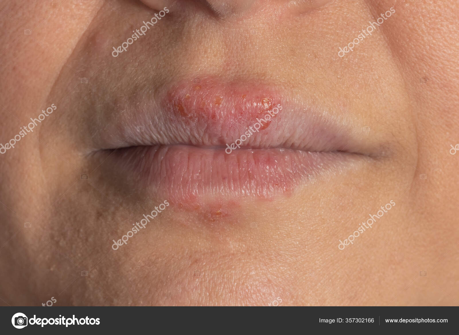 Allergic Reaction Metal Lips White Woman Stock Photo by ©VictorMulero