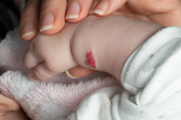 Αγγείωμα Ροζ Αιμαγγείωμα Στο Χέρι Ενός Μωρού — Φωτογραφία Αρχείου