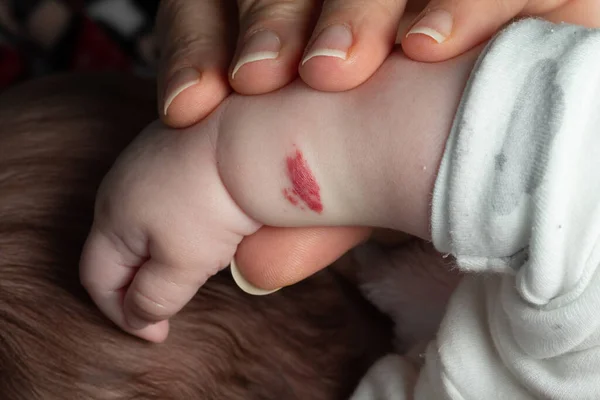 Angioma Hemangioma Rosa Braço Bebê Dois Meses Idade — Fotografia de Stock