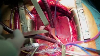 Doktorlar cerrahlar açık kalp ameliyatı gerçekleştirmek. Yakın çekim