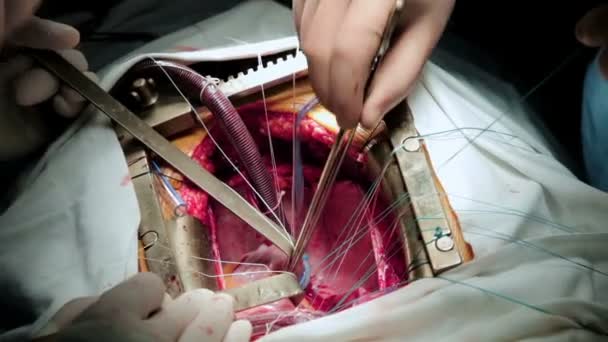 Los médicos cirujanos realizan una cirugía a corazón abierto. Primer plano — Vídeo de stock