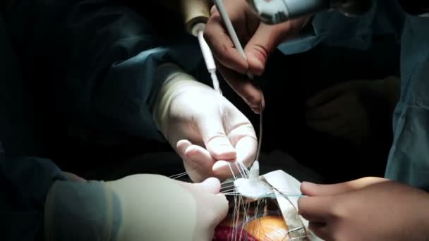Médicos cirurgiões realizam cirurgia cardíaca aberta. Close-up — Vídeo de Stock