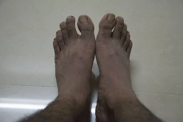 Uzun bir yürüyüşten sonra ıslak çoraplarla