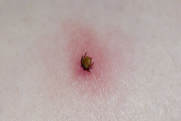 Tick with its head sticking in human skin