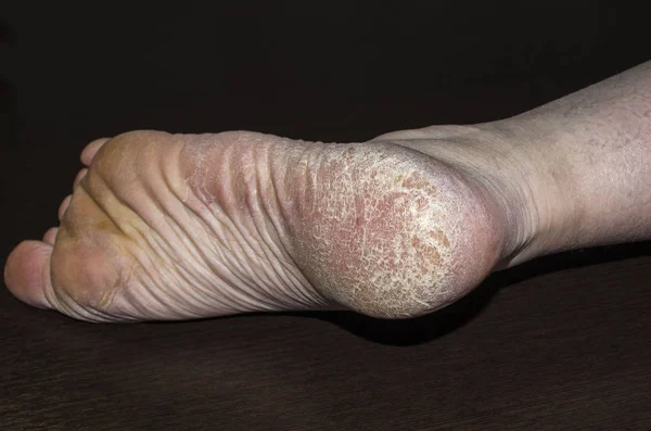 Maïs callus scheurt op een zool hiel voet van dichtbij. Droge huid dermatologie probleem. — Stockfoto