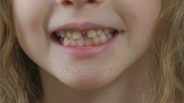 Gülümseyen ve diş etleri ve dişleri diş çürüğü, sarı lekeler ile gösterilen küçük çocuk