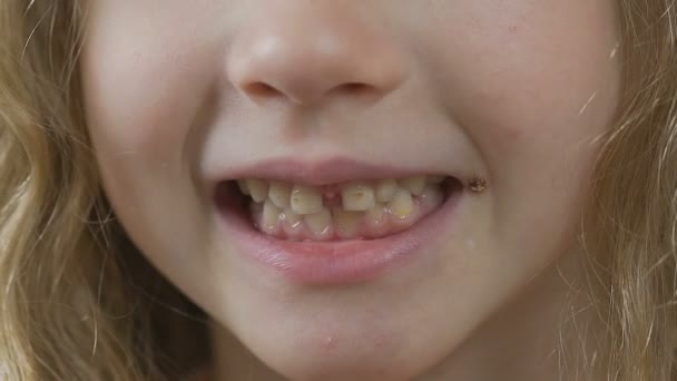 Niño pequeño sonriendo y mostrando encías y dientes con caries dental, manchas amarillas — Vídeos de Stock