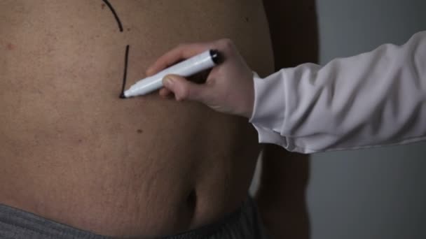 Plastischer Chirurg markiert Schnittlinien am dicken Bauch übergewichtiger Männer, Fettleibigkeit — Stockvideo